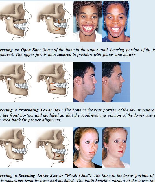 Chin Dental Surgery 1 chin dental surgery