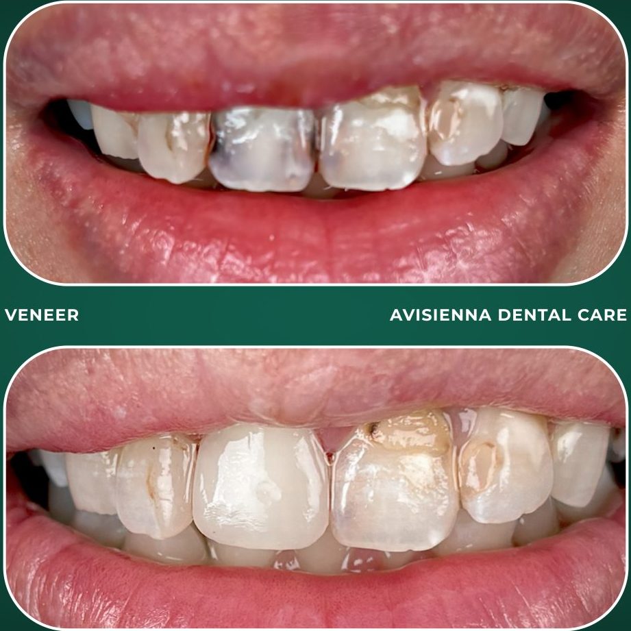 Klinik Pergigian Avisienna - Scaling, Teeth Whitening, Veneer, Aligner & Braces Larkin 1 klinik pergigian avisienna scaling teeth whitening veneer aligner braces larkin