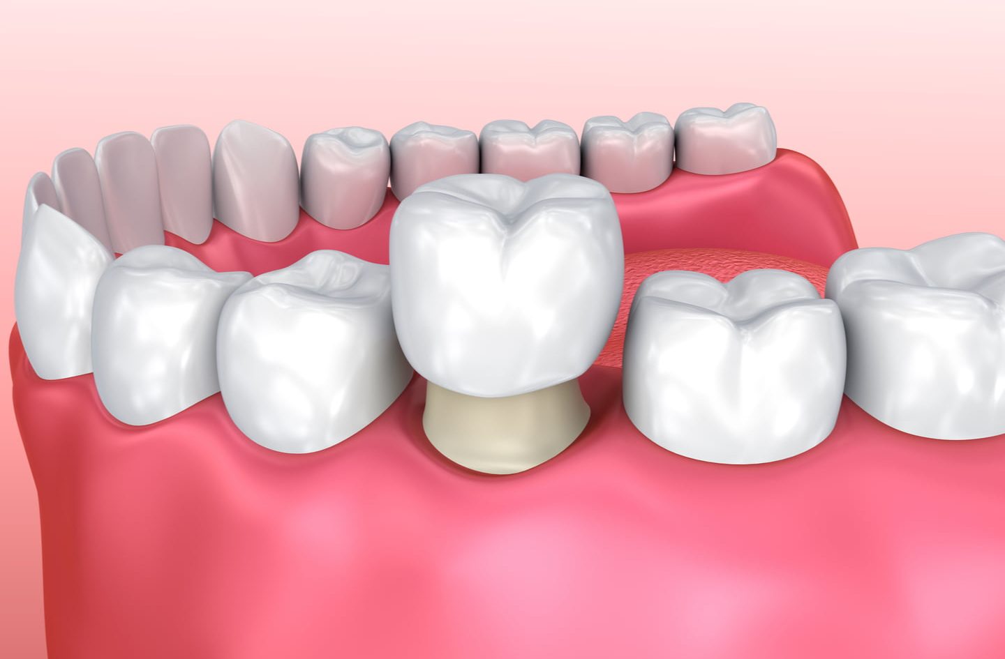 Klinik Pergigian Crown Care Dental 1 klinik pergigian crown care dental