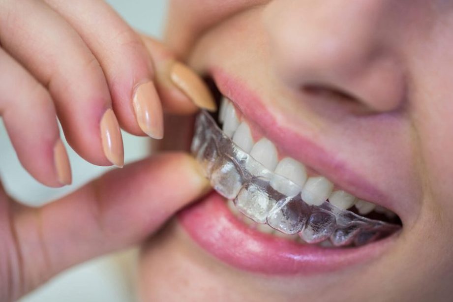 klinik pergigian habib dental braces clear aligner jb