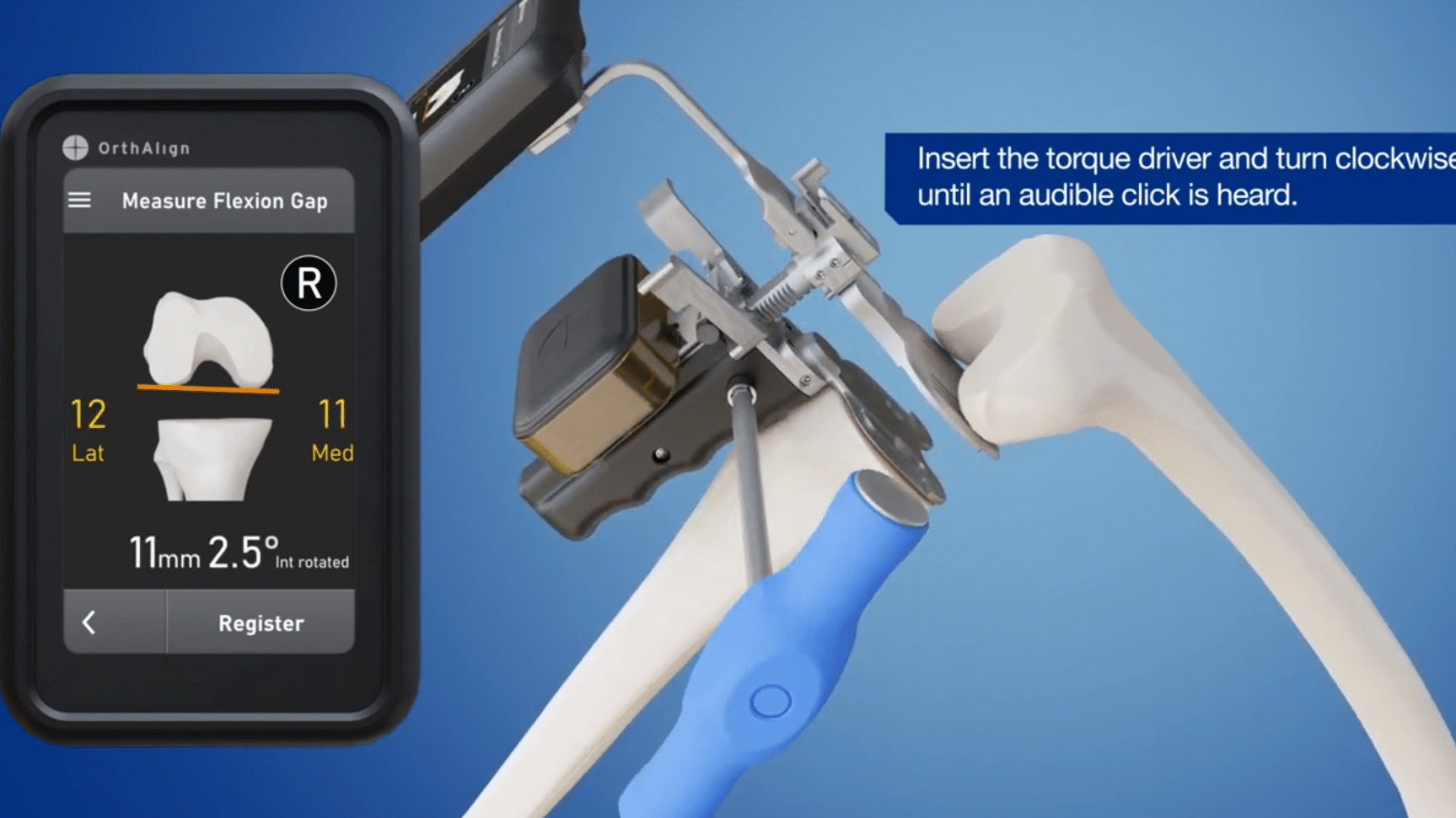 orthoalign 1 orthoalign