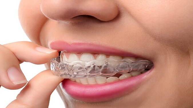 qm dental clinic kulai invisalign braces provider