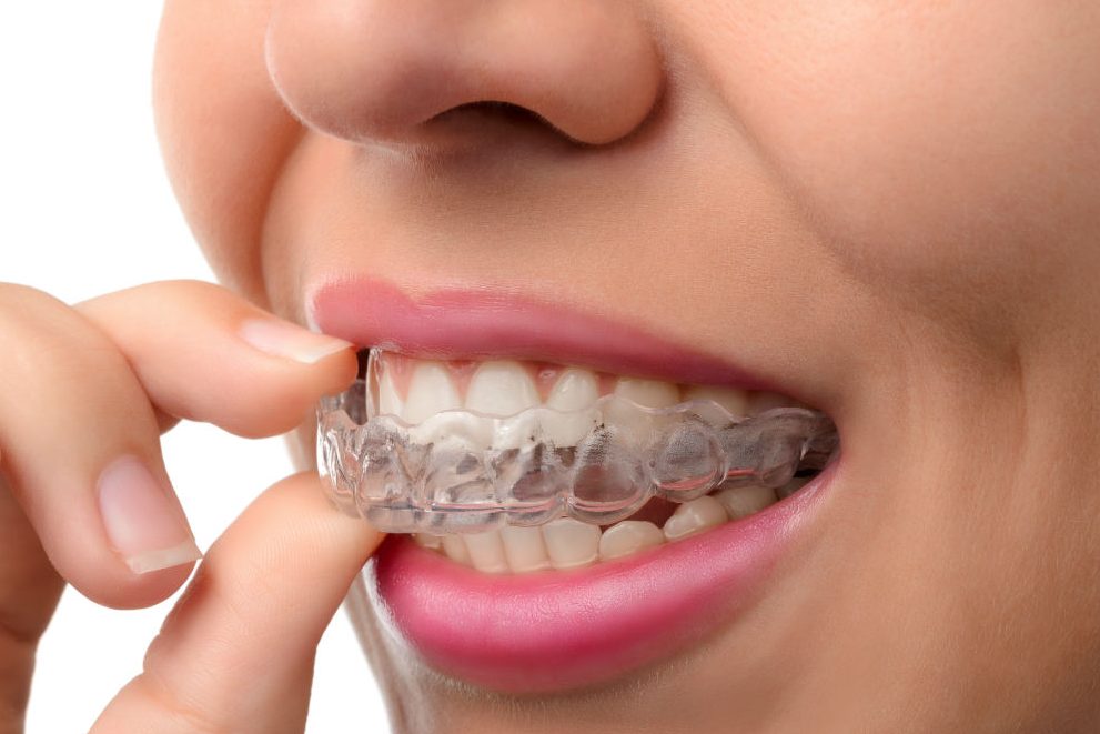 Q&M Dental Clinic - Tangkak (Invisalign Braces Provider) 1 qm dental clinic tangkak invisalign braces provider
