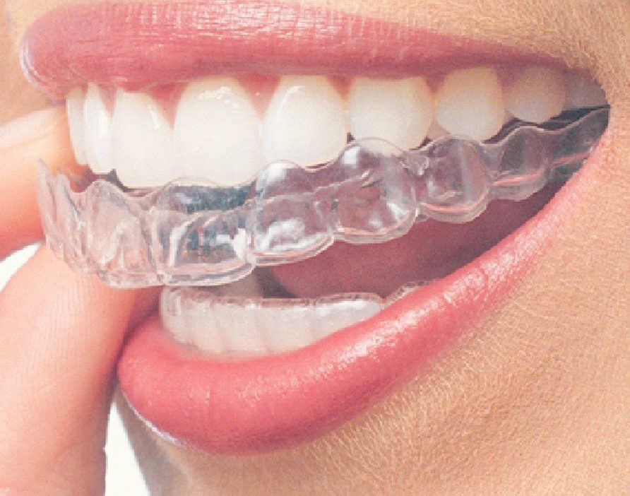 qm dental clinic ulu tiram invisalign braces provider